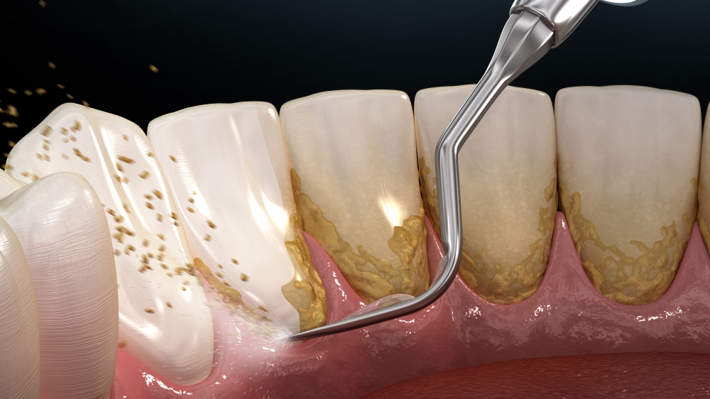 Có những nguyên tắc giữ gìn sức khỏe răng miệng không liên quan đến cạo vôi răng?