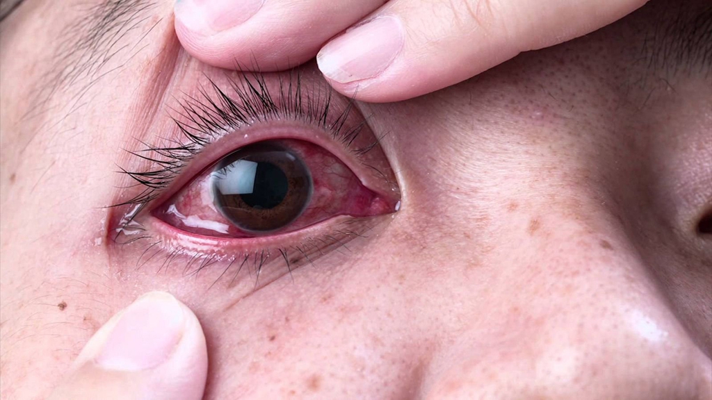Thuốc nhỏ mắt nào giúp giảm cảm giác nóng rát và khô khi hàn?
