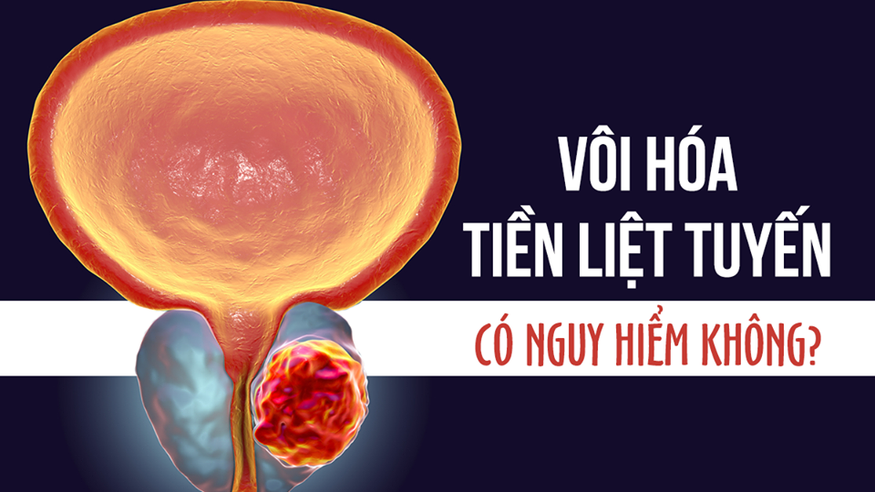 Giải đáp: Bị vôi hóa tiền liệt tuyến nguy hiểm không?