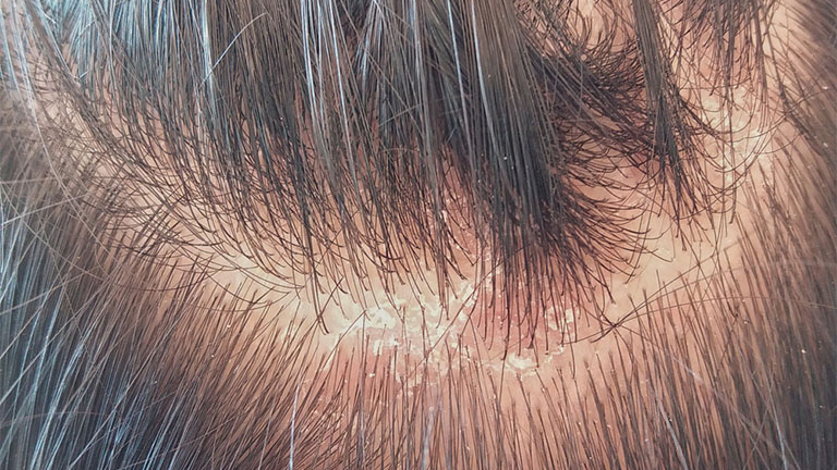 Bệnh nấm da đầu có thể lây từ người sang người không?
