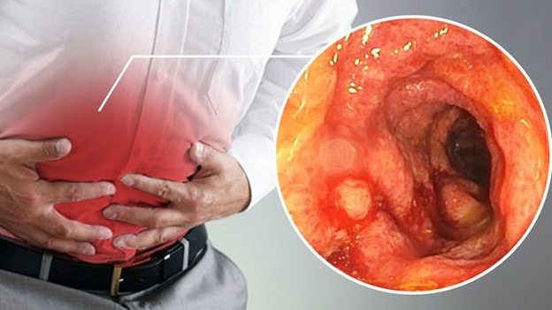 [Giải đáp] Những điều cần biết về sinh thiết dạ dày