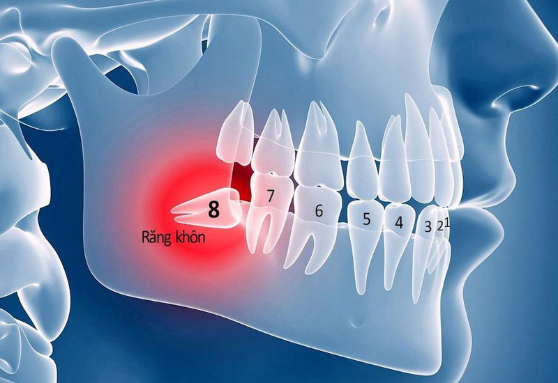 Giải đáp: Răng khôn là gì? Đau răng khôn nên làm gì? 1