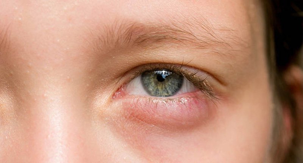Liệu việc dùng kem dưỡng mắt có thể giảm bọng mắt bị đỏ không?
