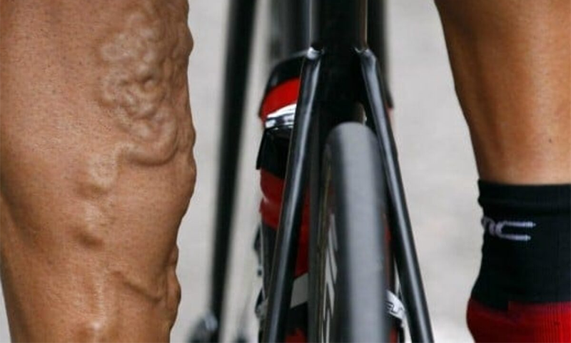 Giải đáp thắc mắc: Giãn tĩnh mạch chân có nên đạp xe? 3