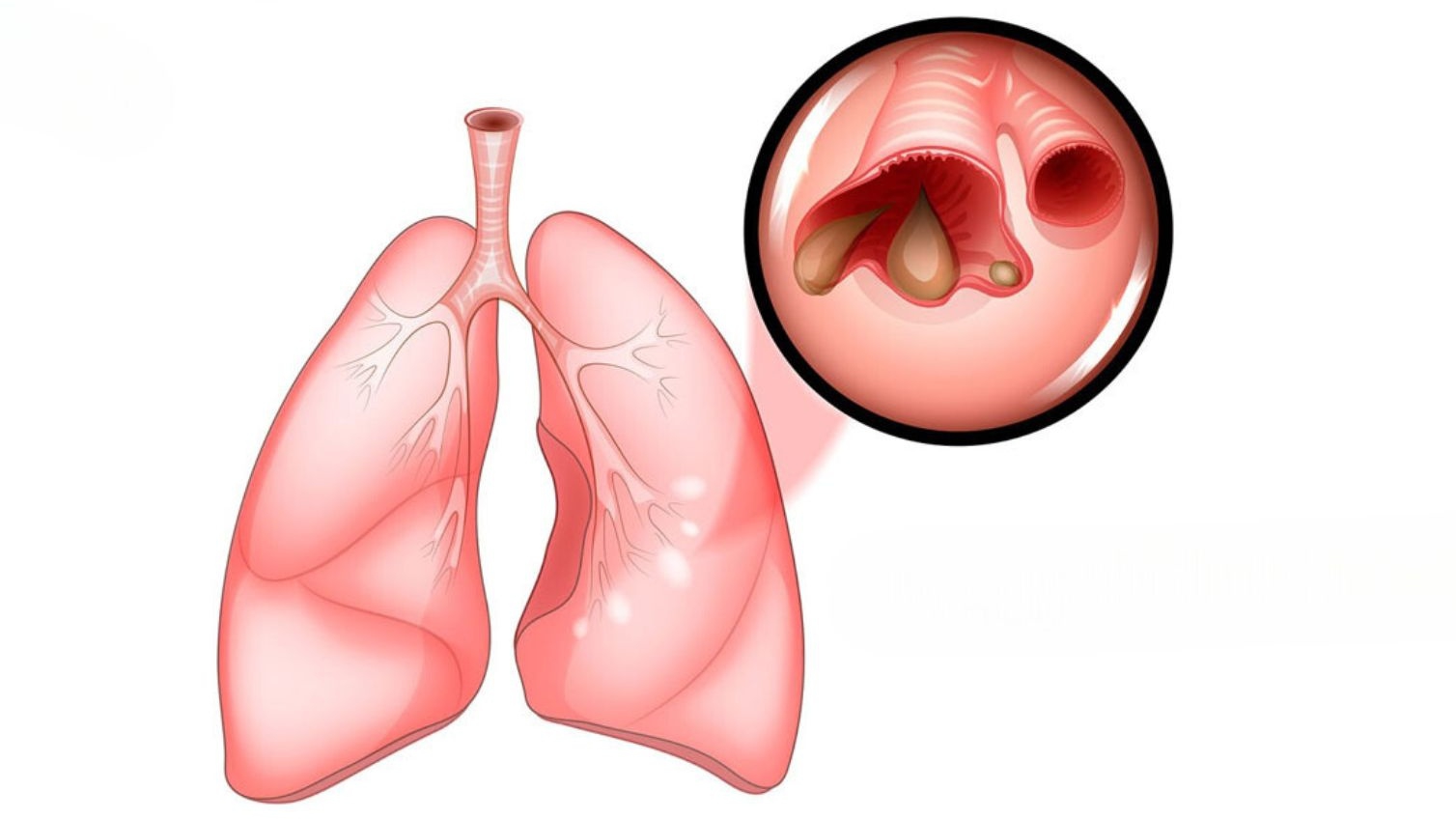 Giãn phế quản bội nhiễm: Nguyên nhân, triệu chứng và cách điều trị