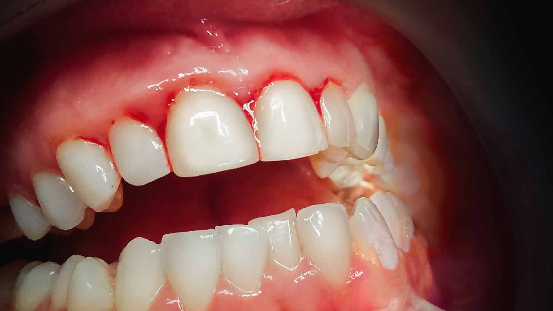 Gingival Index là gì? Các yếu tố ảnh hưởng đến chỉ số lợi (Gingival Index)