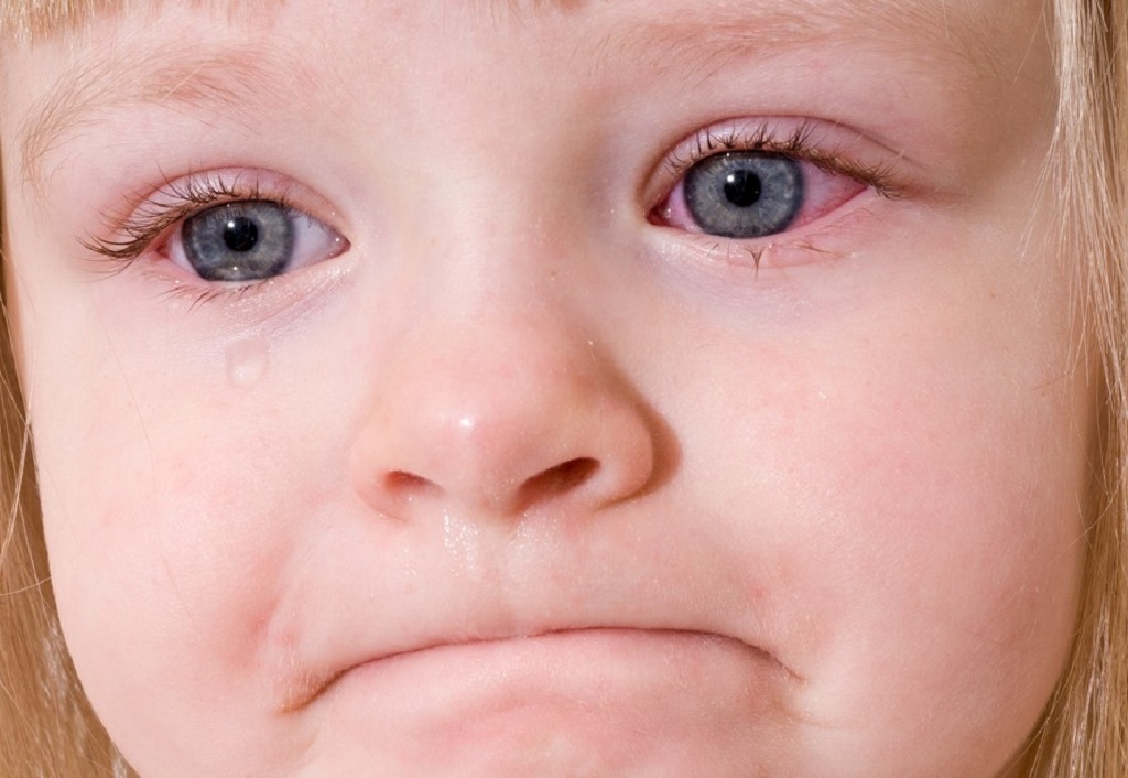 Các triệu chứng khác đi kèm với đau mắt đỏ và sốt ở trẻ là gì?
