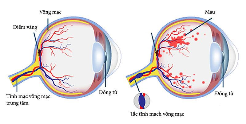 Glocom tân mạch là gì? Những vấn đề cần biết về Glocom tân mạch2.jpg