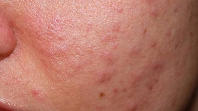 [Góc giải đáp] Hướng dẫn các cách điều trị mụn bọc không đầu