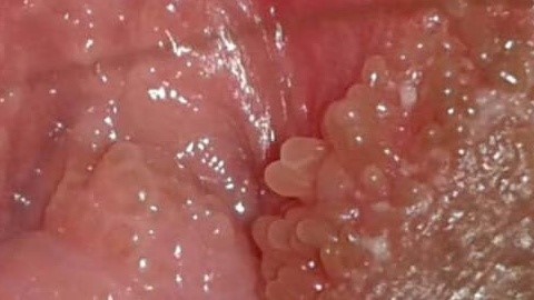 [Góc giải đáp] Sùi mào gà tự đào thải được hay không?