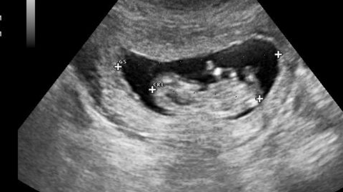 Khi nào thì tim thai bắt đầu hình thành trong túi thai?
