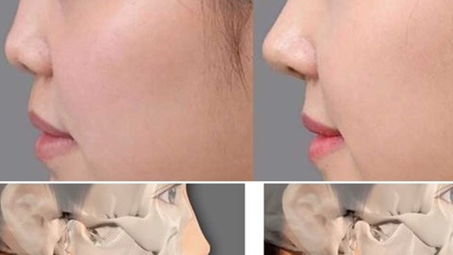 [Góc hỏi đáp] Tập Mewing bao nhiêu phút một ngày là hợp lý?