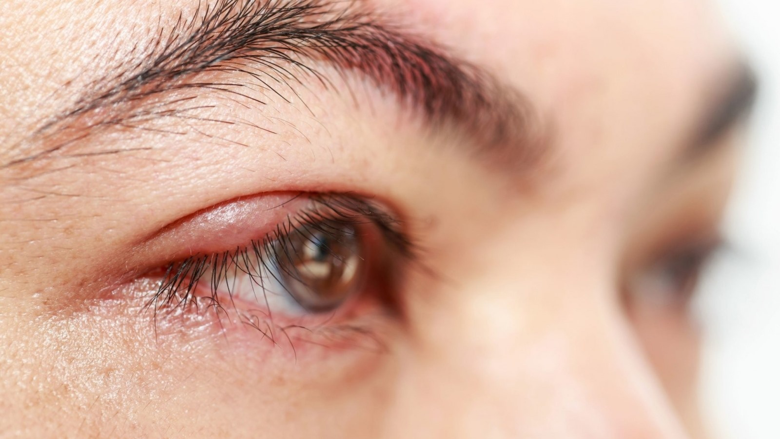 Top 7 mẹo chữa lẹo mắt cột chỉ hiệu quả cho mắt căng thẳng