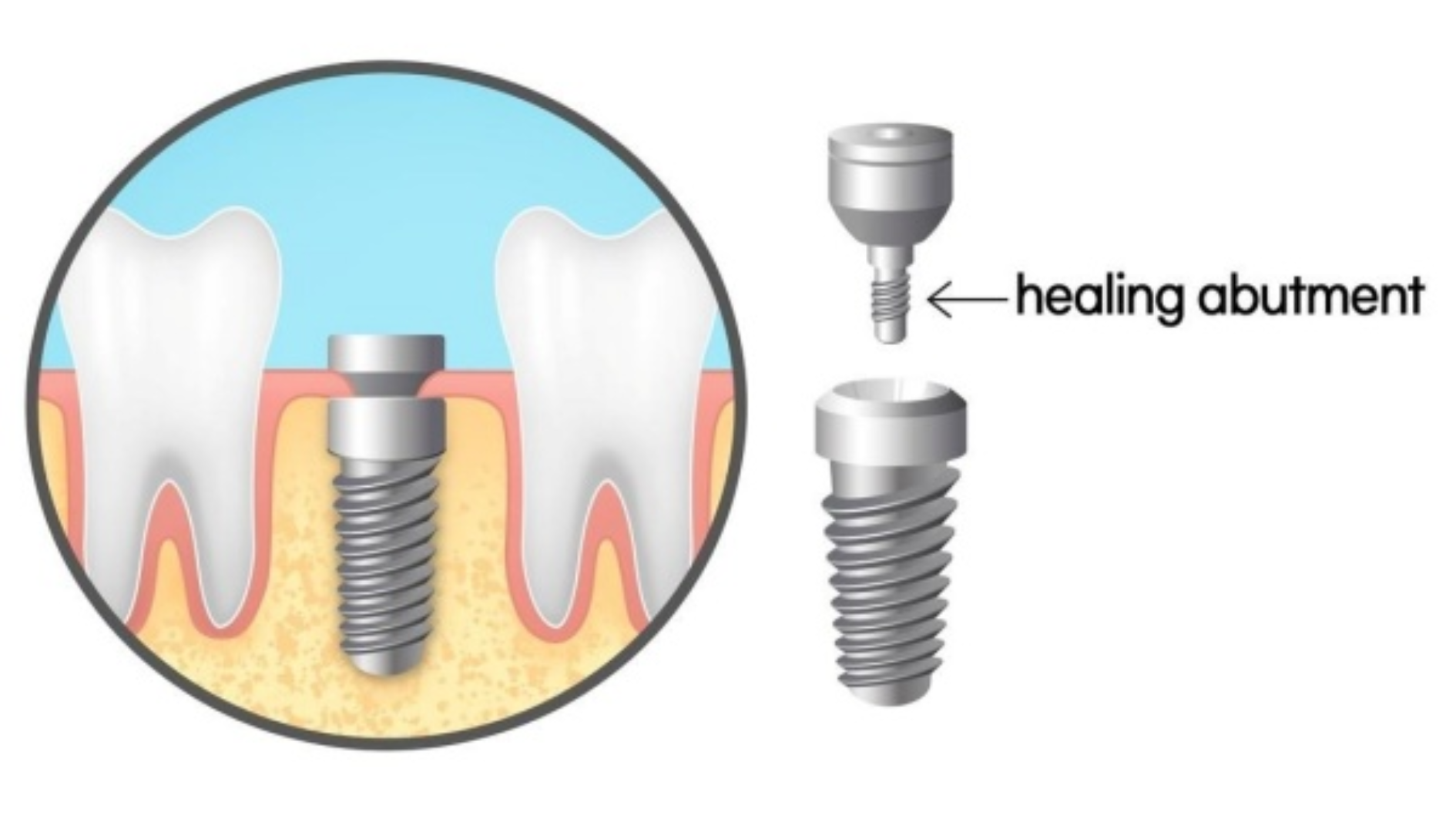 Healing implant là gì? Các đặc điểm nổi bật của Healing implant