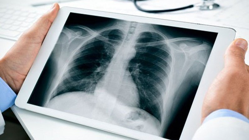 Biểu hiện và triệu chứng rốn phổi đậm là gì mà bạn nên biết