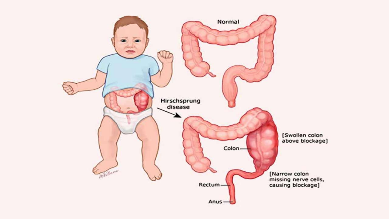 Hirschsprung là bệnh gì? Nguyên nhân, triệu chứng, phương pháp chẩn đoán và điều trị bệnh