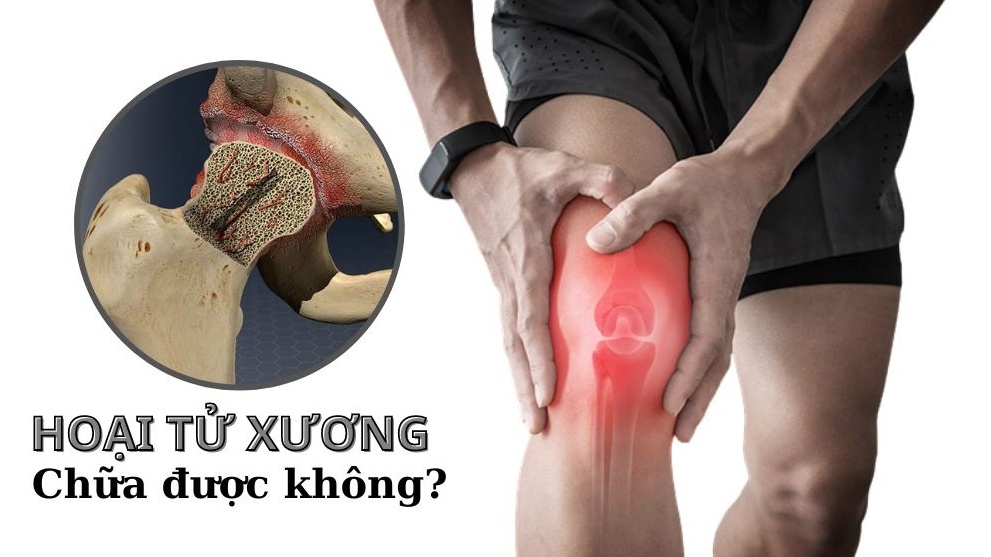 Hoại tử xương có chữa được không?