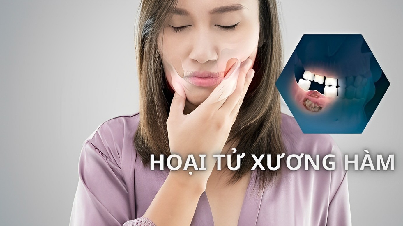 Tìm hiểu chi tiết về bệnh hoại tử xương hàm