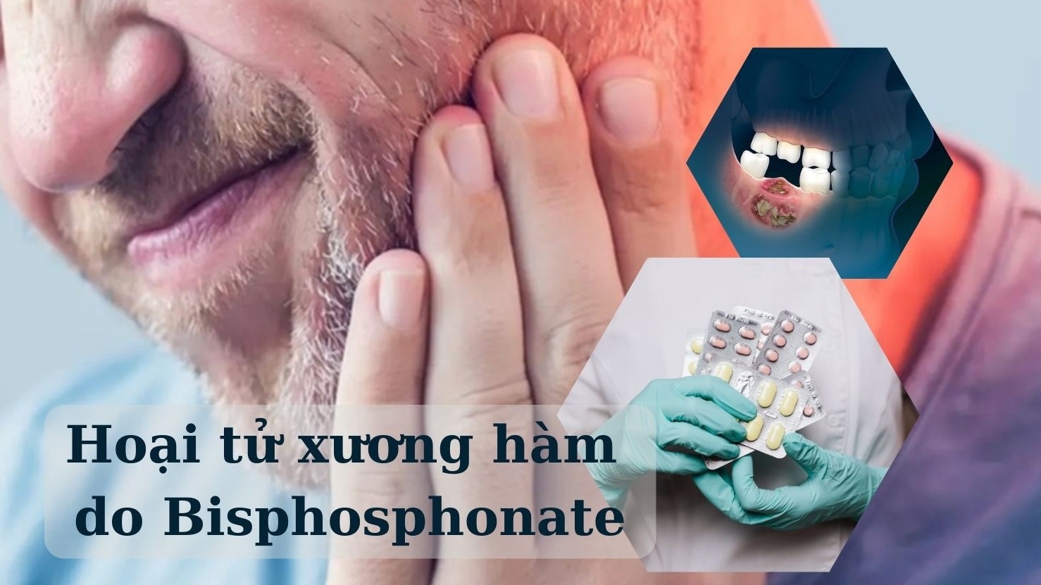 Những điều cần biết về hoại tử xương hàm do Bisphosphonate