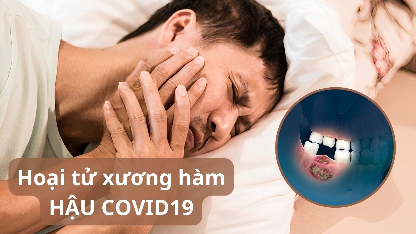 Tìm hiểu chi tiết về tình trạng hoại tử xương hàm hậu Covid