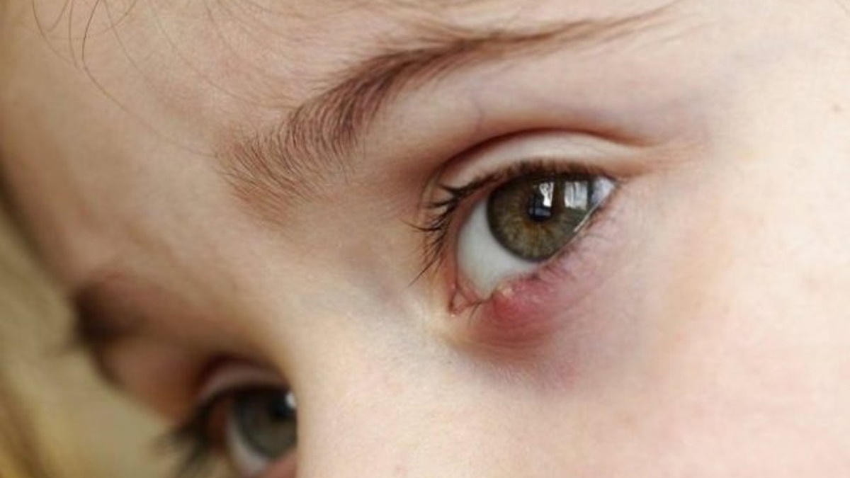 Tại sao nước bọt được coi là một phương pháp chữa lẹo mắt hiệu quả?
