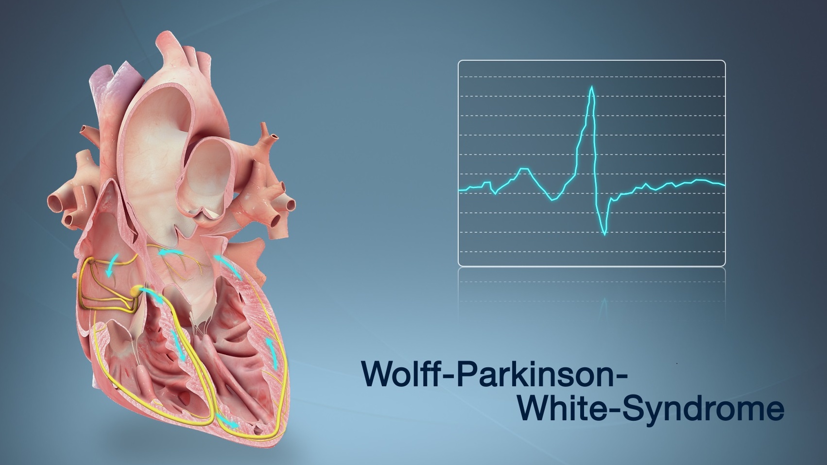 Hội Chứng Wolff-Parkinson-White có chữa khỏi được không?