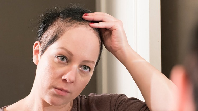 Những điều bạn nên biết về hội chứng nghiện giật tóc 3