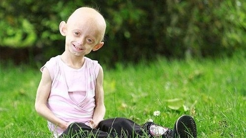 Hội chứng Progeria là gì? Triệu chứng ra sao 1