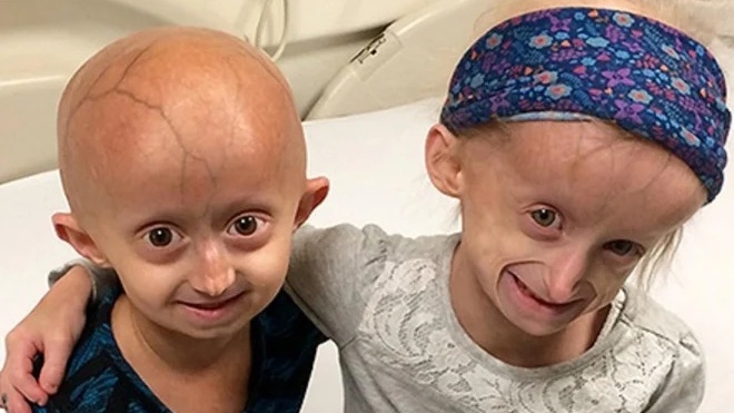 Hội chứng Progeria là gì? Triệu chứng ra sao 3