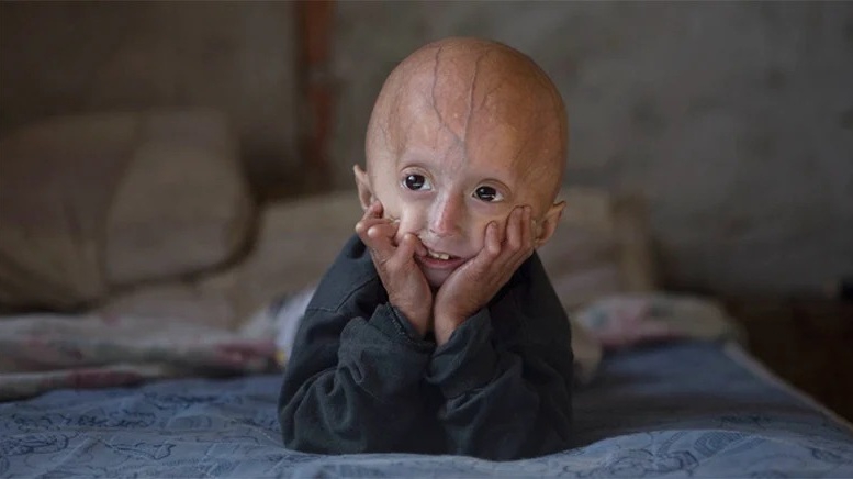 Hội chứng Progeria là gì? Triệu chứng ra sao 4