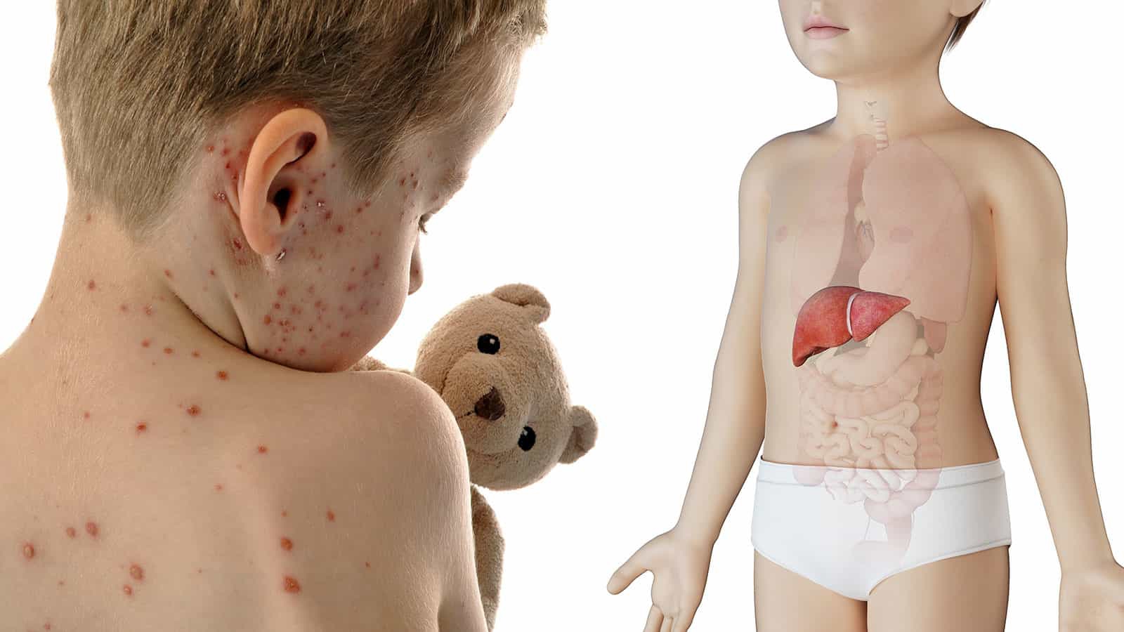 Hội chứng Reye là gì? Nguyên nhân, triệu chứng và cách điều trị