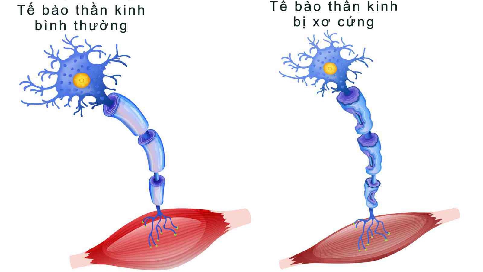 Hội chứng xơ cứng teo cơ một bên và những điều bạn cần biết