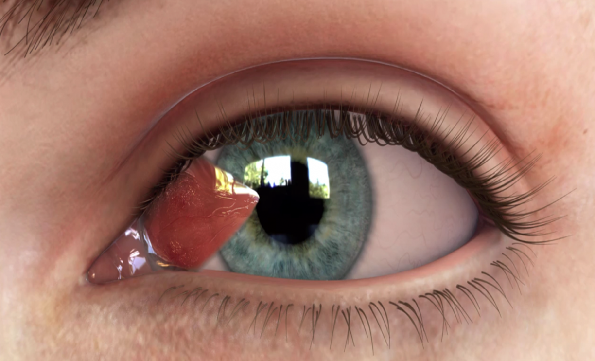 Bệnh mộng mắt có những triệu chứng như thế nào?

