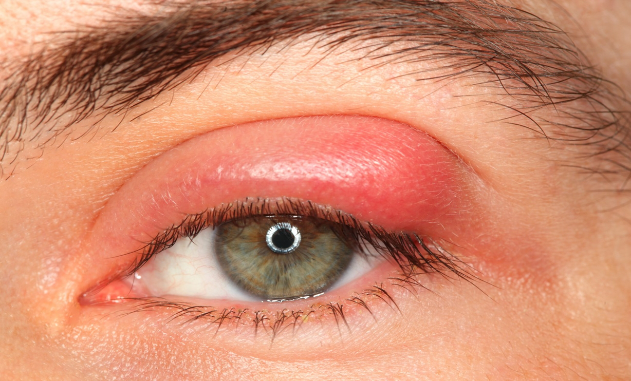 Làm sao để chăm sóc mắt đau mắt đỏ đúng cách?

