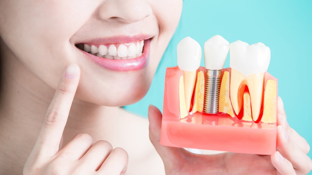 Hối hận khi trồng implant giá rẻ?