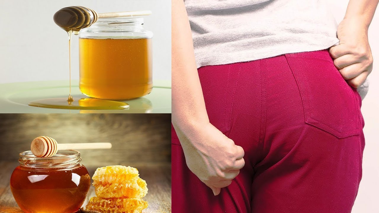 Hướng dẫn cách chữa bệnh trĩ bằng mật ong