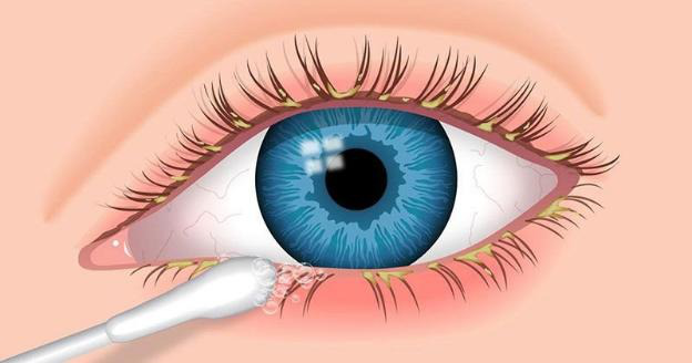 Hướng dẫn cách vệ sinh mắt tại nhà trong từng trường hợp 2