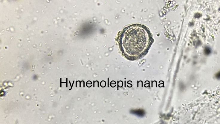 Hymenolepis nana: Triệu chứng nhiễm trùng và cách phòng tránh  2