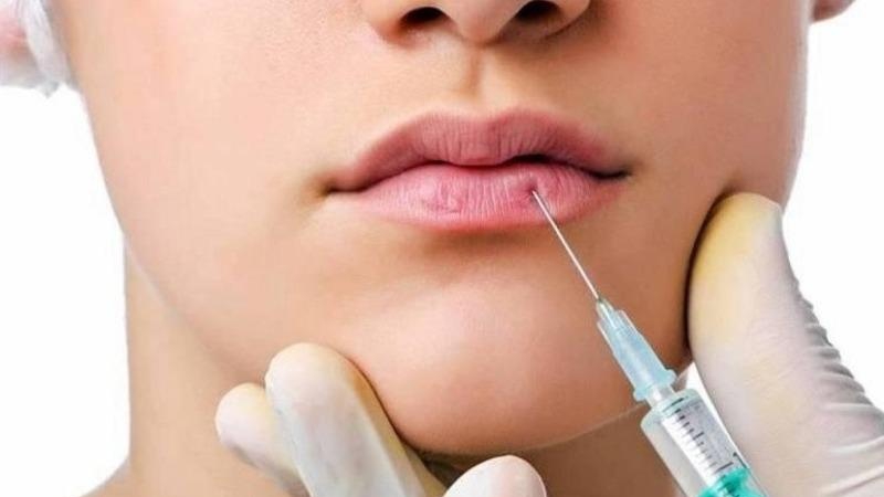 Nguyên nhân tiêm filler môi 2 tháng bị sưng? Có cách khắc phục không?