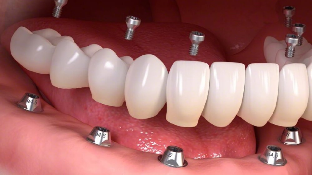 Tại sao phương pháp trồng răng Implant Tekka được ưa chuộng hiện nay?