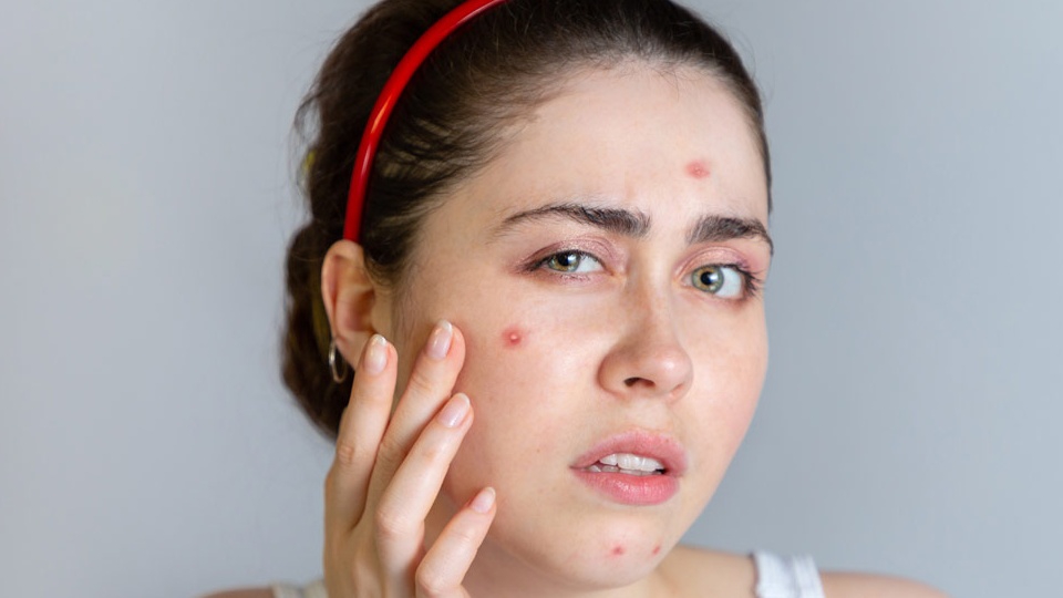 Tác dụng phụ chính của isotretinoin là gì?
