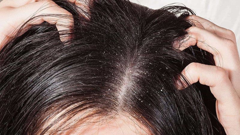 Khắc phục nấm da đầu với dầu gội Nazorel Shampoo Ciclopirox Olamine 1