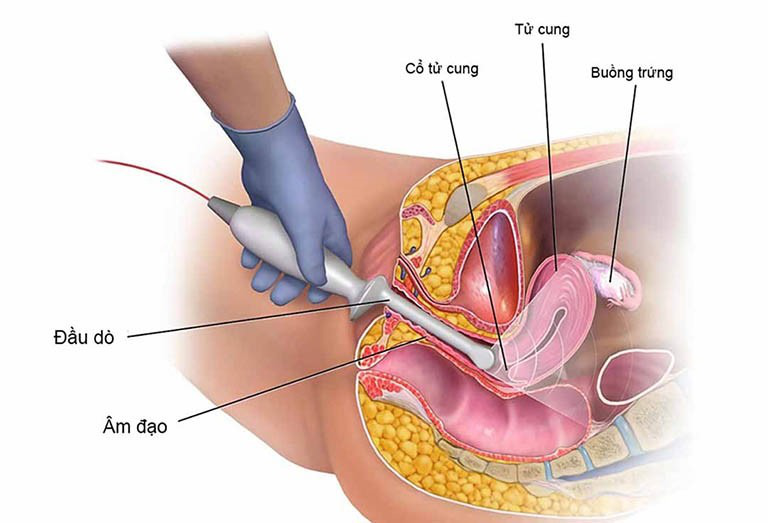Khâu eo cổ tử cung có đi lại được không? 1