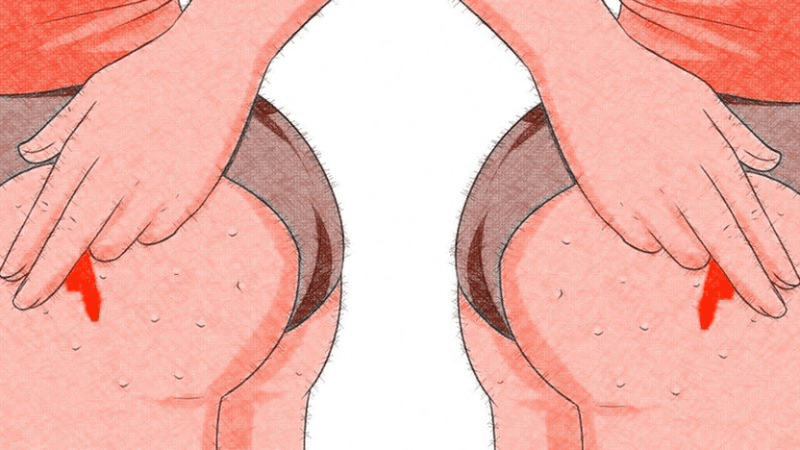  Mụn nhọt ở mông bị vỡ : Nguyên nhân và cách khắc phục