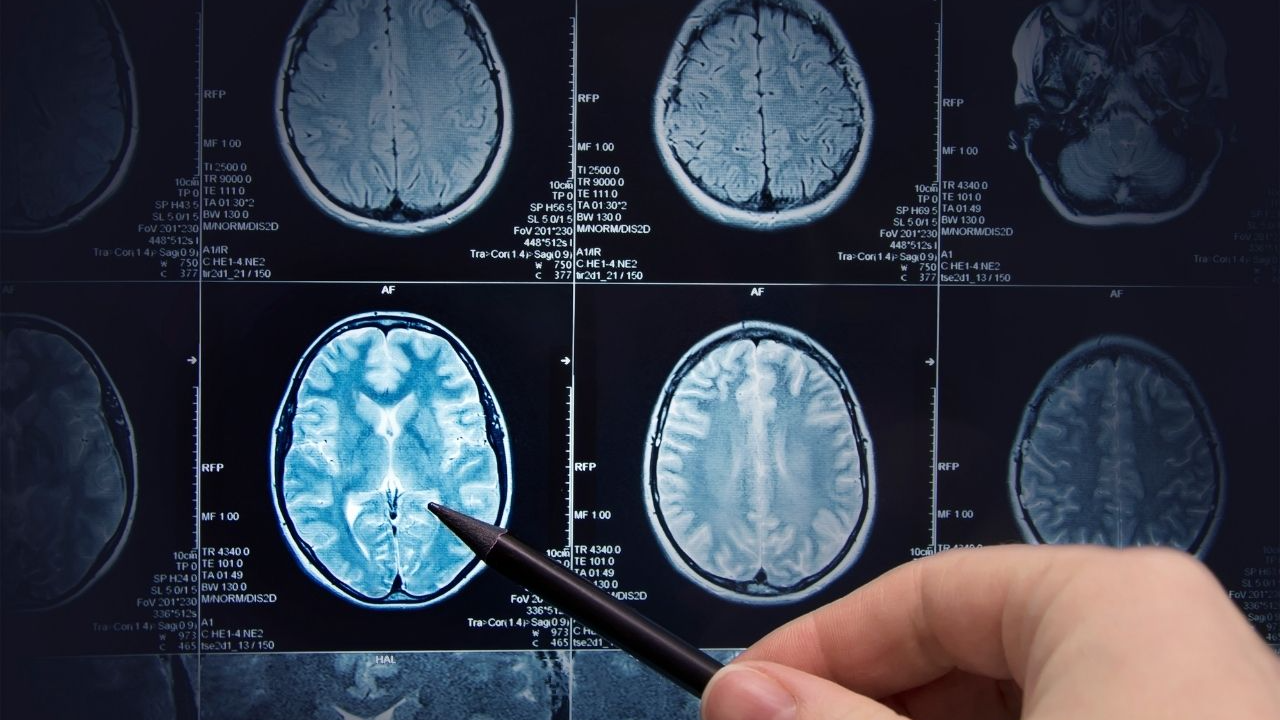 Nền Chụp Ct Não để Chẩn đoán đột Quỵ Khối U Và Mạch Máu Hình Chụp Và Hình  ảnh Để Tải Về Miễn Phí - Pngtree