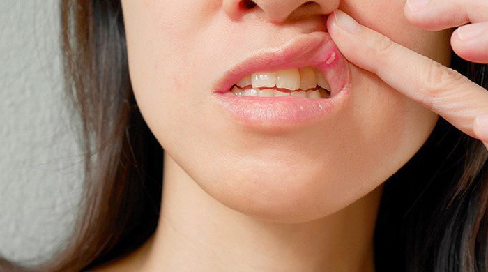 Khoang miệng bị rộp: Nguyên nhân và các triệu chứng thường gặp 1