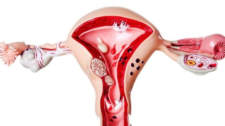 Lạc nội mạc tử cung tầng sinh môn là gì? 1