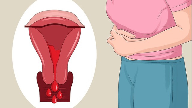 Lạc nội mạc tử cung tầng sinh môn là gì? 2