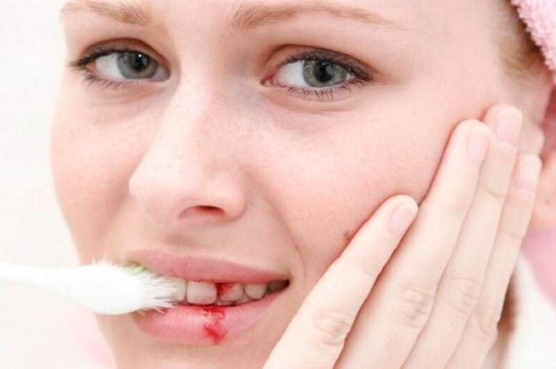 Làm gì khi chảy máu chân răng? 2