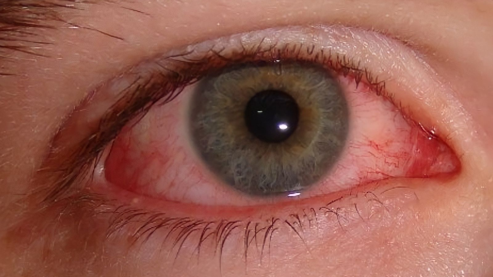 Các biện pháp điều trị mắt nổi gân đỏ hiệu quả?
